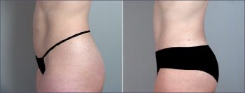 Parker Tummy Tuck Patient 10