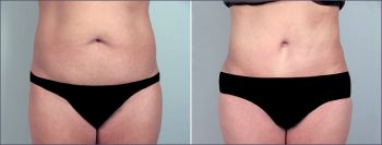 Parker Tummy Tuck Patient 11