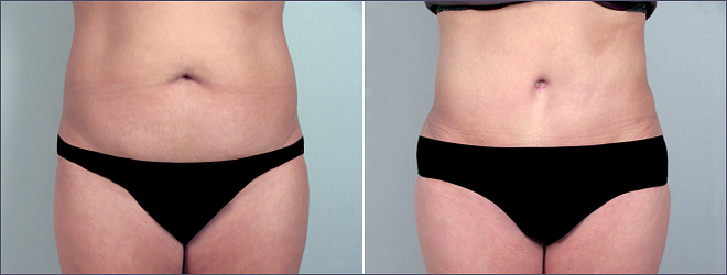 Parker Tummy Tuck Patient 11