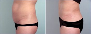 Parker Tummy Tuck Patient 11