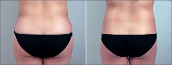 Parker Tummy Tuck Patient 11