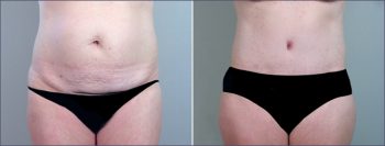 Parker Tummy Tuck Patient 9