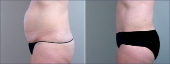 Parker Tummy Tuck Patient 9