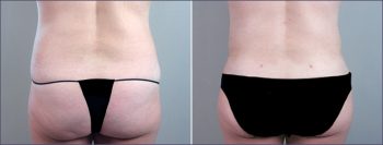 Parker Tummy Tuck Patient 9