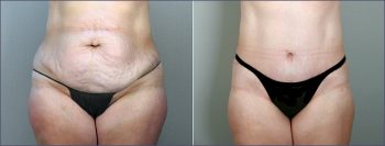 Parker Tummy Tuck Patient 12
