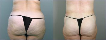 Parker Tummy Tuck Patient 12