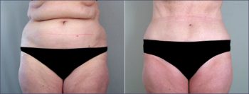 Parker Tummy Tuck Patient 1