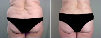 Parker Tummy Tuck Patient 1