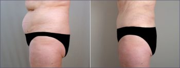 Parker Tummy Tuck Patient 1
