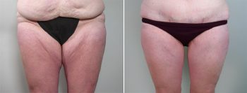 Thigh & Body Lifting Surgery Patient 5