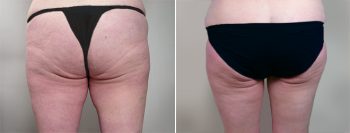 Thigh & Body Lifting Surgery Patient 5