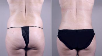 Mommy Makeover Patient 8