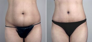 Parker Tummy Tuck Patient 25
