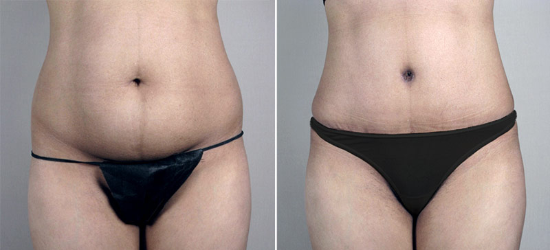Parker Tummy Tuck Patient 25
