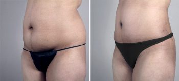 Parker Tummy Tuck Patient 25