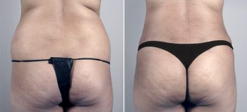 Parker Tummy Tuck Patient 25