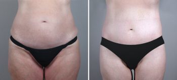 Parker Tummy Tuck Patient 22