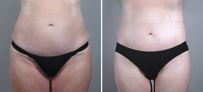 Parker Tummy Tuck Patient 22