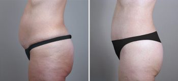 Parker Tummy Tuck Patient 22