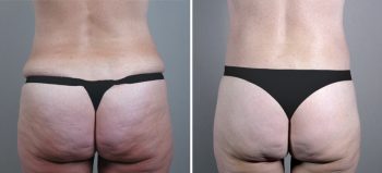 Parker Tummy Tuck Patient 22