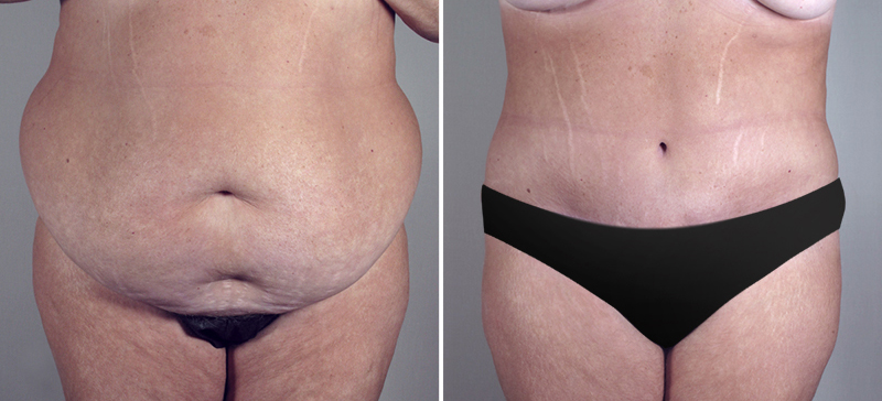 Parker Tummy Tuck Patient 6