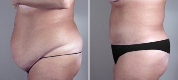 Parker Tummy Tuck Patient 6