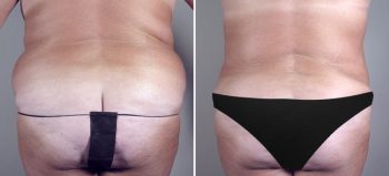 Parker Tummy Tuck Patient 6