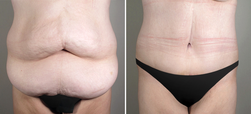 Parker Tummy Tuck Patient 7