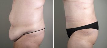 Parker Tummy Tuck Patient 7