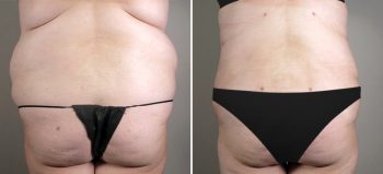 Parker Tummy Tuck Patient 7