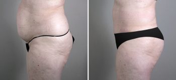 Parker Tummy Tuck Patient 23