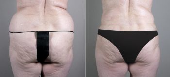 Parker Tummy Tuck Patient 23