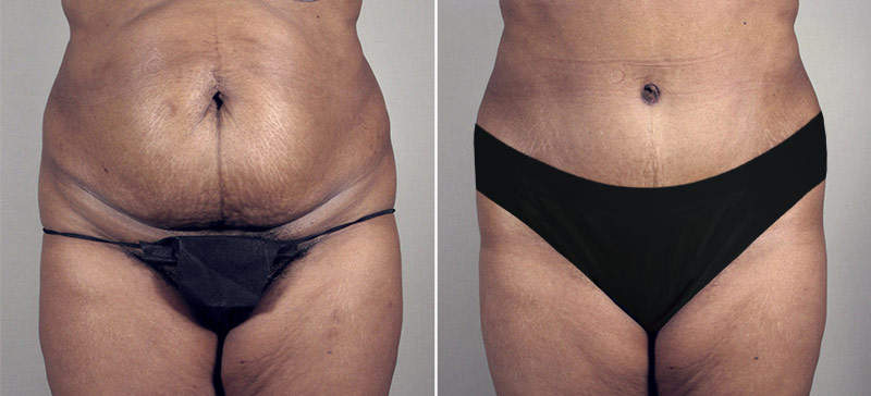 Parker Tummy Tuck Patient 3