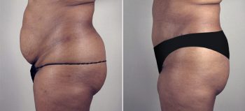 Parker Tummy Tuck Patient 3