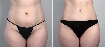 Parker Tummy Tuck Patient 17