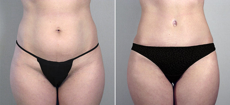 Parker Tummy Tuck Patient 17
