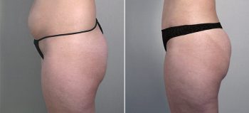 Parker Tummy Tuck Patient 17