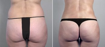 Parker Tummy Tuck Patient 17