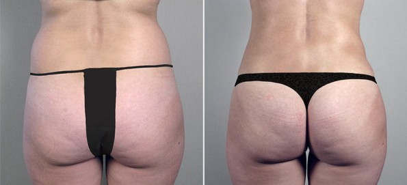 tummy tuck New Jersey Image