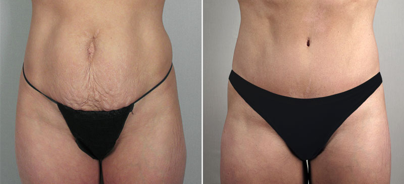 Parker Tummy Tuck Patient 24