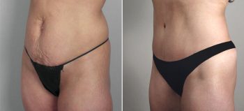 Parker Tummy Tuck Patient 24