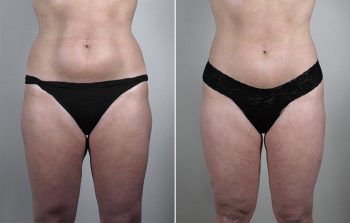 Liposuction Patient 3