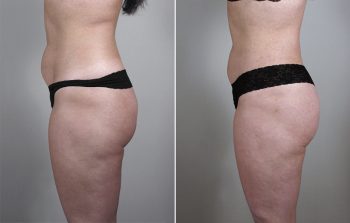 Liposuction Patient 3