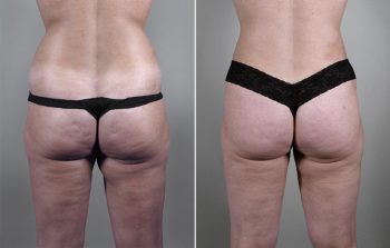 Liposuction Patient 3