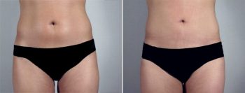 Breast Enlargement (Augmentation) Patient 28