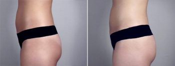 Breast Enlargement (Augmentation) Patient 28