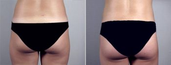 Breast Enlargement (Augmentation) Patient 28