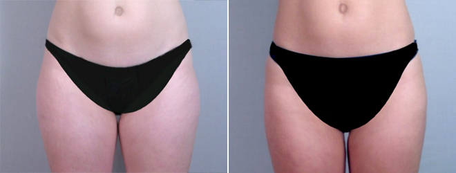 Liposuction Patient 5