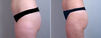 Liposuction Patient 5