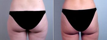 Liposuction Patient 5